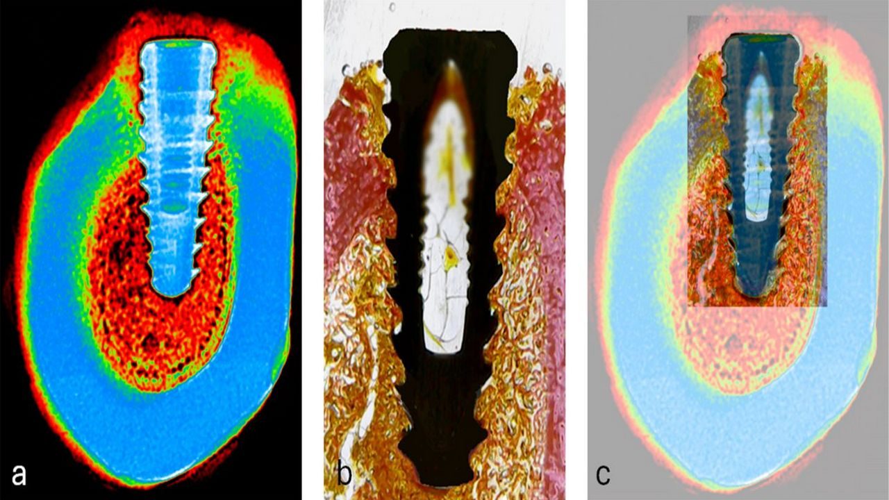 Osseointegration Explained in Plain Language